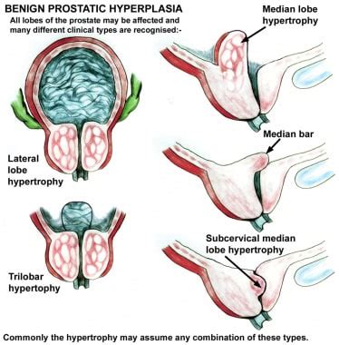 Transurethral Resection of the Prostate: Overview, Treatment ...