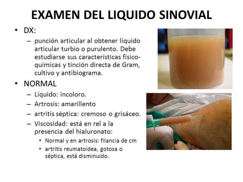 Liquido sinovial derrame