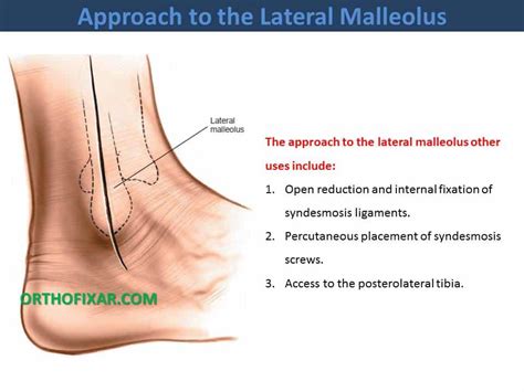 Approach To The Lateral Malleolus • OrthoFixar 2024