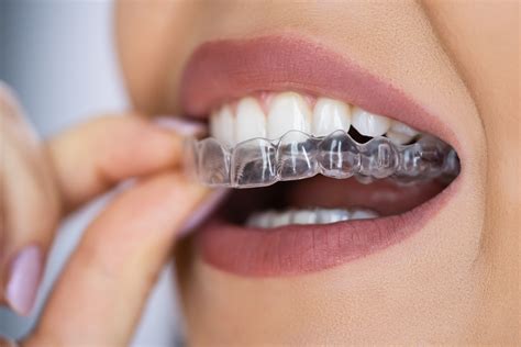 Your Guide to Dental Aligners | Discreet, Removable Solutions to ...