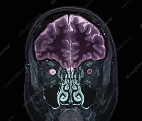 Optic nerve multiple sclerosis symptom, MRI scan - Stock Image - C033 ...