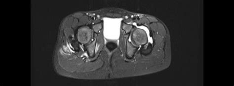 (a)-(c) MRI hip joint contrast. | Download Scientific Diagram