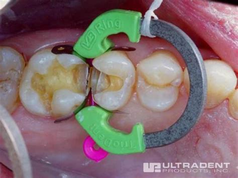 Triodent® V3 Ring-Sectional Matrix Ring