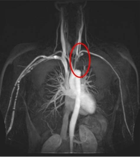 MRI showing complete occlusion of proximal 4 cm of left | Open-i