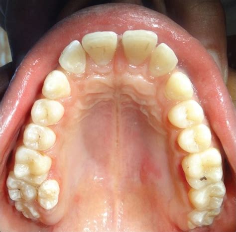 Supernumerary teeth | News | Dentagama