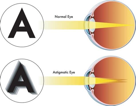 Astigmatisms Eye Chart: Over 171 Royalty-Free Licensable Stock ...