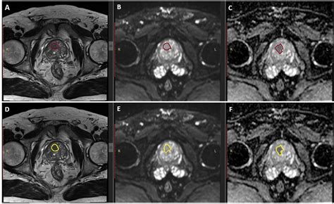 Frontiers | MRI Radiomics in Prostate Cancer: A Reliability Study