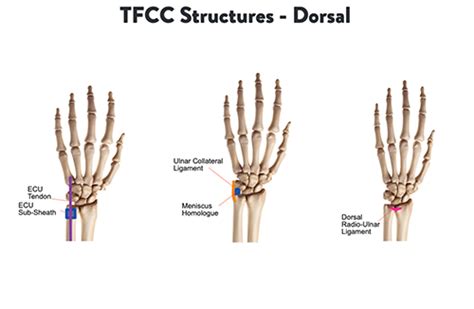 Ulnar Sided Wrist Pain | Hand Therapy Academy