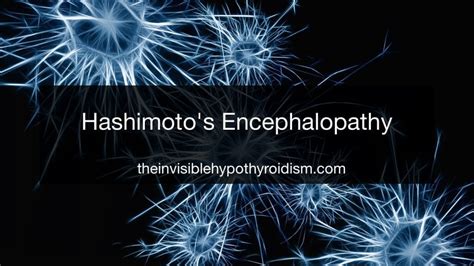 Hashimoto's Encephalopathy - The Invisible Hypothyroidism