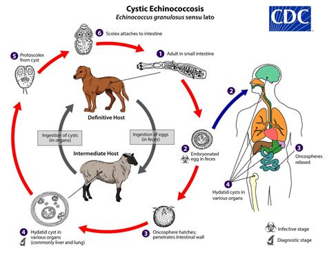 Hydatid cyst causes, symptoms, diagnosis, treatment & prognosis