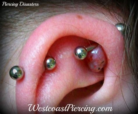 Westcoast Piercing And Ink: Large Keloid on Ear