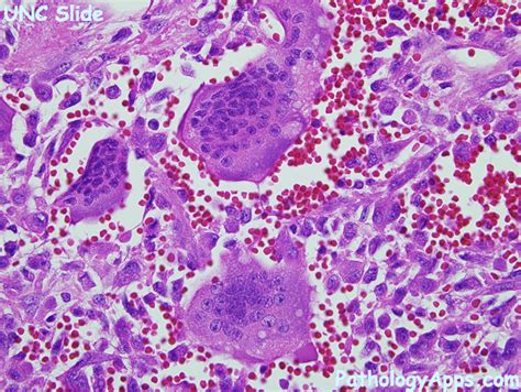 giant cell tumor bone, soft tissue histology