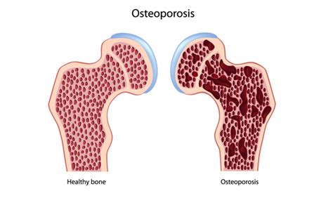 New Treatment Options for Brittle Bone Disease