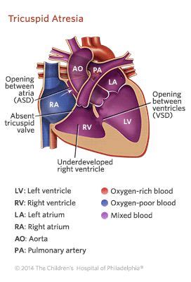 Tricuspid Atresia | Cardiac catheterization, Congenital heart disease ...