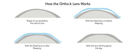 Orthokeratology For Adults at Lakeline Vision Source's Myopia Control ...