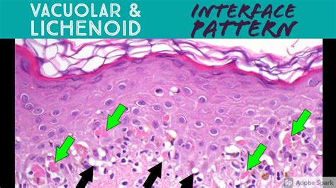 Vacuolar vs Lichenoid Interface Dermatitis Pattern - Inflammatory ...