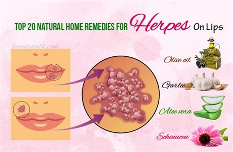 Top 20 Natural Home Remedies For Herpes On Lips