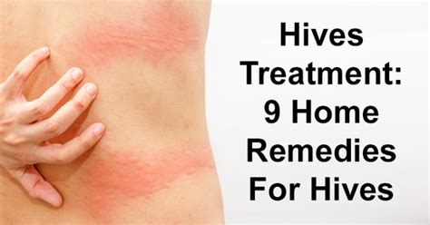 Hives Treatment: 9 Home Remedies For Hives - David Avocado Wolfe