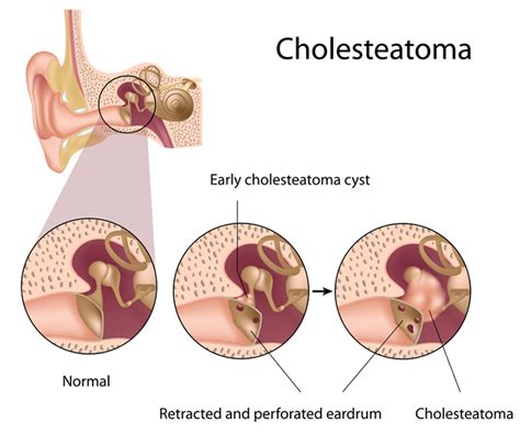 Cholesteatoma Symptoms, Causes, Diagnosis & Best Treatment