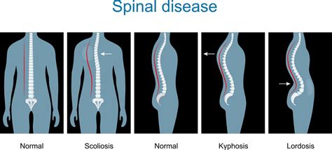 Understanding Spinal Curvatures Kyphosis Lordosis And Scoliosis | The ...