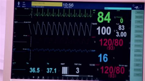 ICU Monitor Showing Patient's Condition, High Temperature, Arrhythmia ...