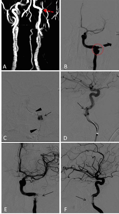 MRA and DSA. A: Pre-operative MRA shows a large and irregular false ...