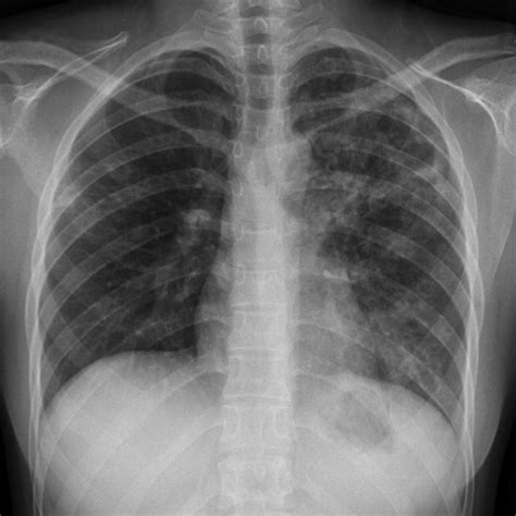 Tuberculosis Lung X Ray