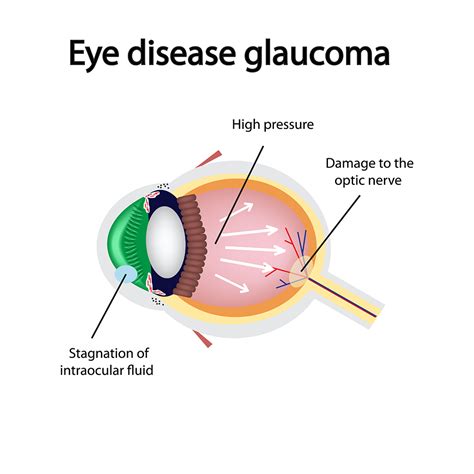 Ways to Protect yourself from Glaucoma - ReliableRxPharmacy Blog ...