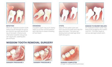 Wisdom Teeth Removal – Rickard Dental Centre