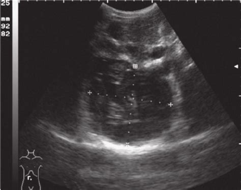 Liver ultrasound evidenced in Case 1 a large hydatic cyst with ...