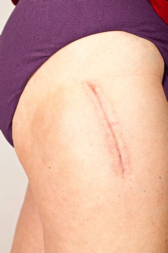 Hip Replacement Surgery Scar Stock Photo - Download Image Now - iStock