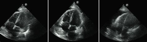 A, B, C (left to right). Postoperative TTE four-chamber view ...