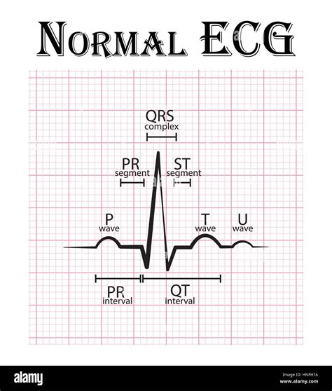 Normal ECG ( Electrocardiogram ) ( P wave , PR segment , PR interval ...