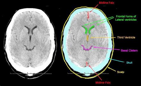 CRASH - CTScan Enlargments