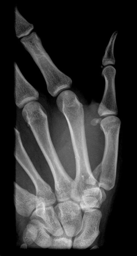 Bennett's fracture - wikidoc