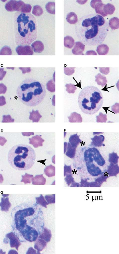 Dohle Bodies In Neutrophils / Google Image Result For Http Ashimagebank ...