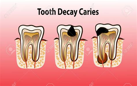 Symptoms and Treatments of Dental Caries - Check Biotech First