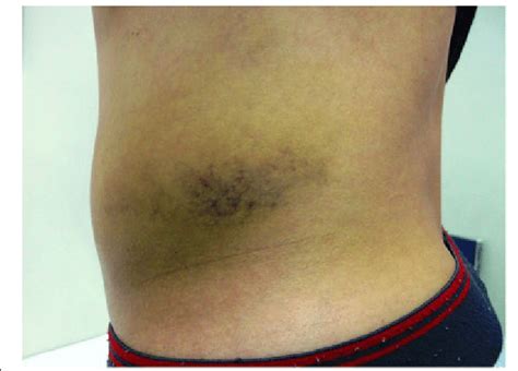 Ecchymosis Vs Hematoma