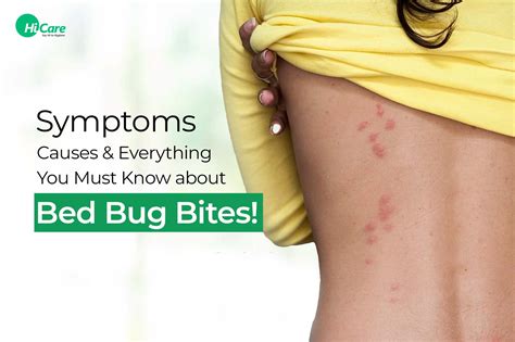 Bed Bugs Bite: Symptoms, Diagnosis and treatment | HiCare