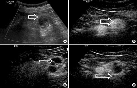 Renal Cell Carcinoma Ultrasound