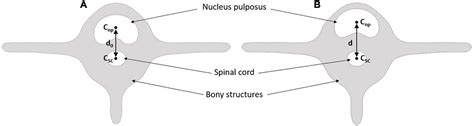 Nucleus Pulposus Mri