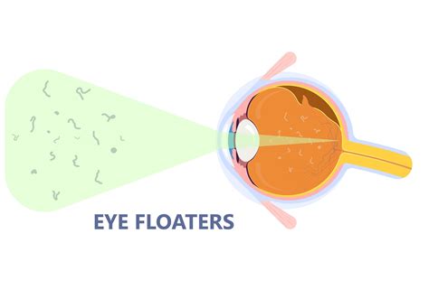 What Doctor Do I See for Eye Floaters? | Ottawa, ON