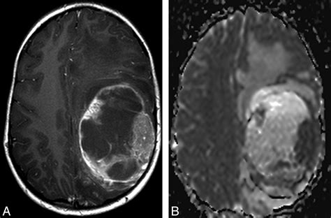 Pleomorphic Xanthoastrocytoma of Childhood: MR Imaging and Diffusion MR ...