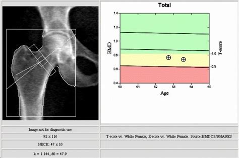 Bone Density Scan Results / DXA Tests: What you must know / The most ...