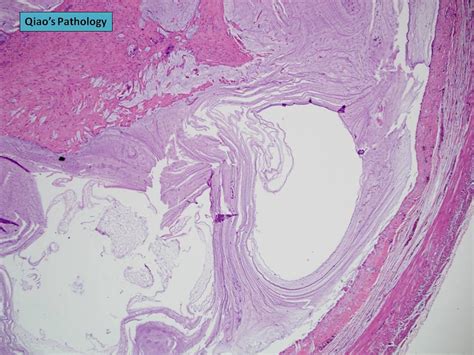 mucocele breast histology