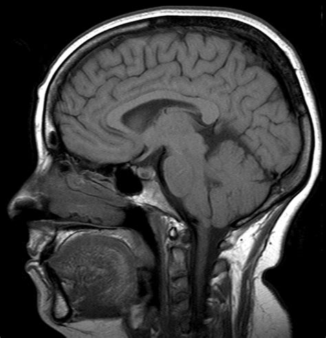 Pituitary Tumor Mri