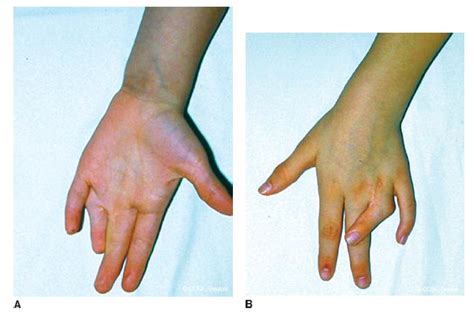 Central Polydactyly | Obgyn Key