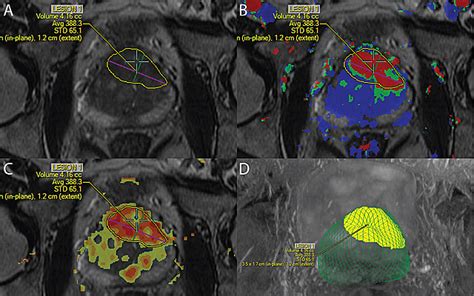 Prostate Cancer Diagnosis Improves with MRI Technology