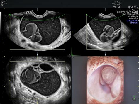 Simple vs. Complex Ovarian Cysts: The Link to Ovarian Cancer ...