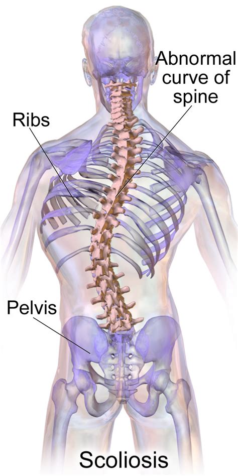 Scoliosis - Wikipedia